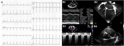 Case Report: Perioperative Kounis Syndrome in an Adolescent With Congenital Glaucoma